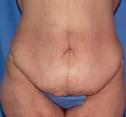 Tummy Tuck before at Robert Kessler MD a Medical Corp in Newport Beach, CA