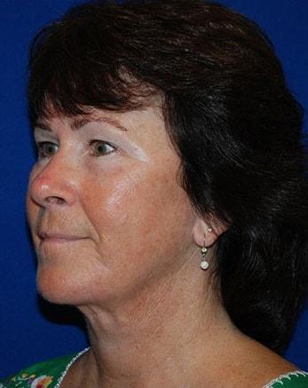 Neck Lift after at Robert Kessler MD a Medical Corp in Newport Beach, CA
