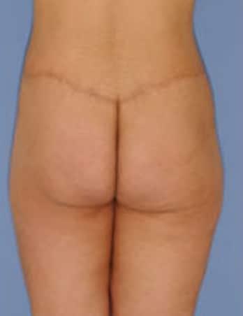 Robert Kessler MD a Medical Corp body lift after — Newport Beach, CA