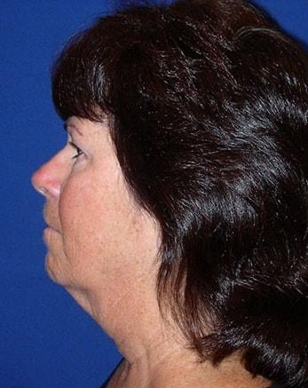 Neck Lift before at Robert Kessler MD a Medical Corp in Newport Beach, CA