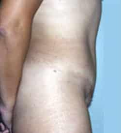 Tummy Tuck after at Robert Kessler MD a Medical Corp in Newport Beach, CA