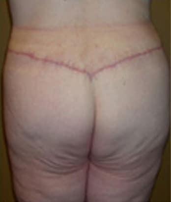 Robert Kessler MD a Medical Corp body lift after — Newport Beach, CA