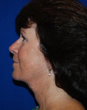 Neck Lift after at Robert Kessler MD a Medical Corp in Newport Beach, CA