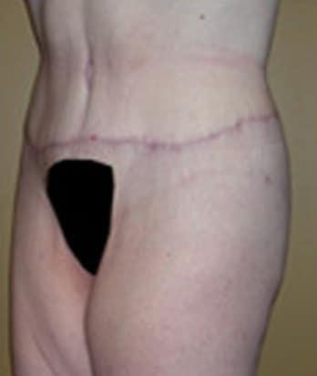 Robert Kessler MD a Medical Corp body lift after — Newport Beach, CA