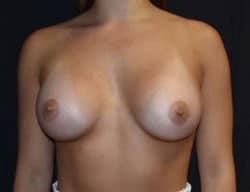Breast Augmentation after at Robert Kessler MD a Medical Corp in Newport Beach, CA