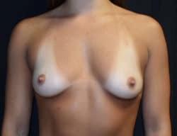 Breast Augmentation before at Robert Kessler MD a Medical Corp in Newport Beach, CA