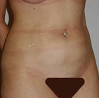 Liposuction before at Robert Kessler MD a Medical Corp in Newport Beach, CA