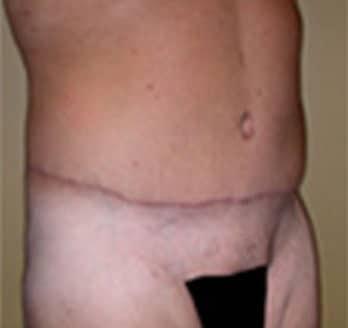 Robert Kessler MD a Medical Corp body lift after — Newport Beach, CA