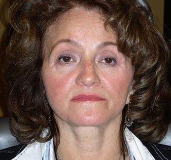 Robert Kessler MD a Medical Corp facelift after — Newport Beach, CA