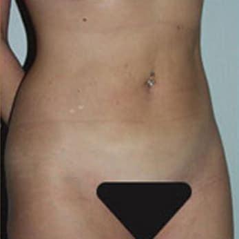 Liposuction after at Robert Kessler MD a Medical Corp in Newport Beach, CA
