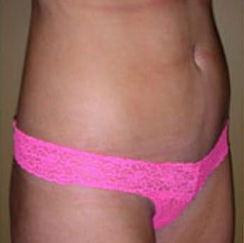 Robert Kessler MD a Medical Corp liposuction after — Newport Beach, CA