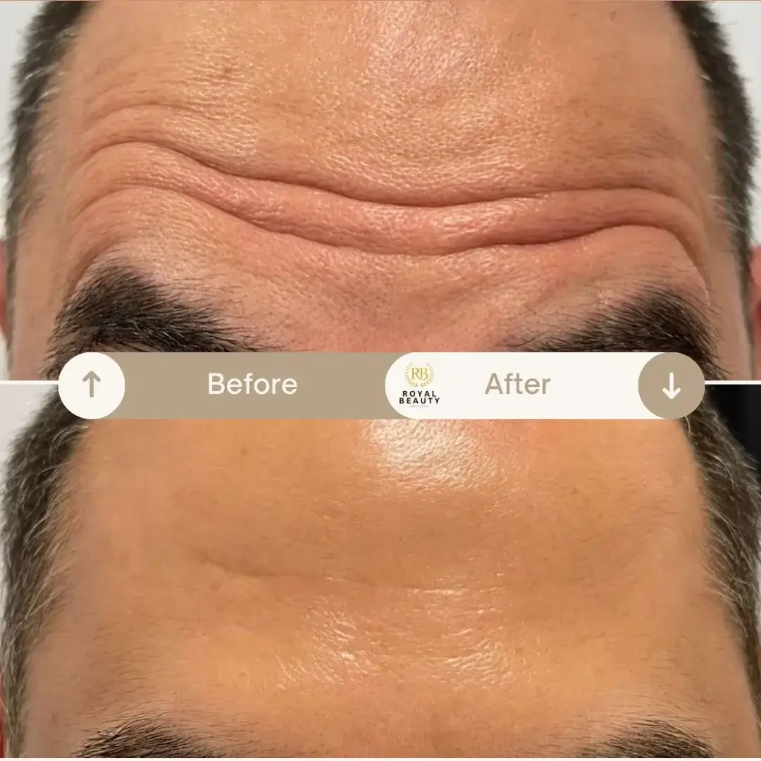 Royal Beauty Aesthetics botox result — Draper, UT