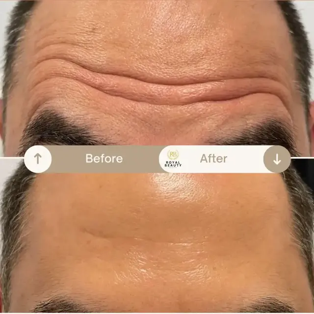 Botox result at Royal Beauty Aesthetics in Draper, UT