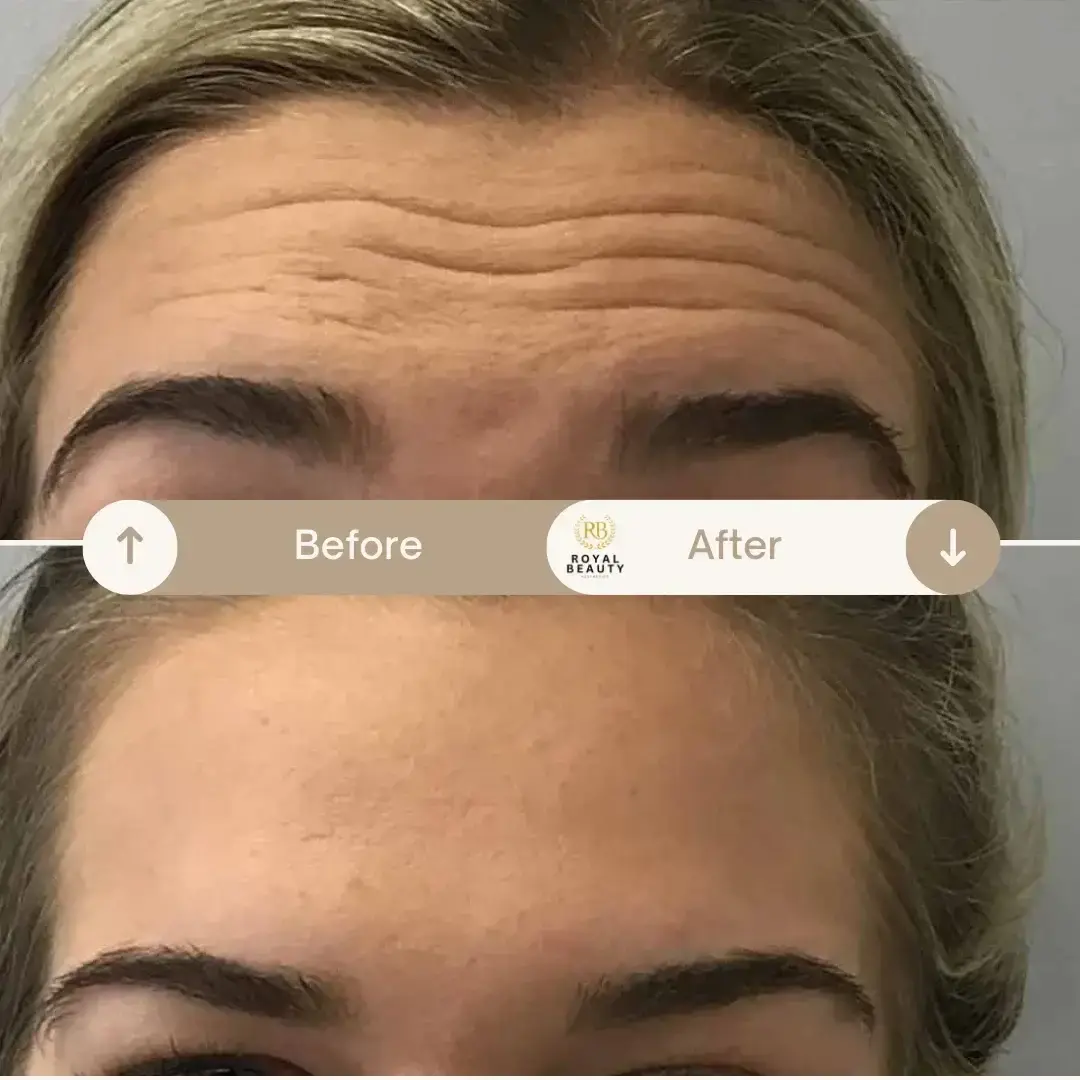 Royal Beauty Aesthetics botox result — Draper, UT