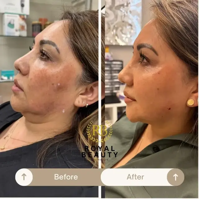 Jawline Filler result at Royal Beauty Aesthetics in Draper, UT