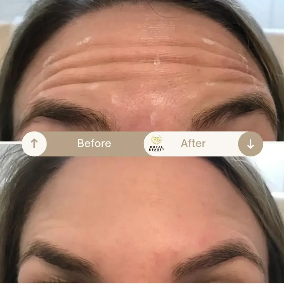 Royal Beauty Aesthetics botox result — Draper, UT