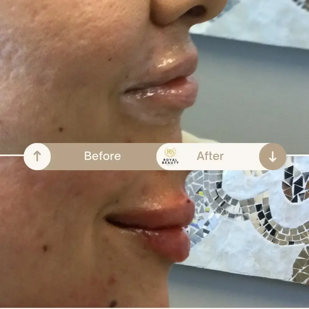 Royal Beauty Aesthetics lip filler result — Draper, UT