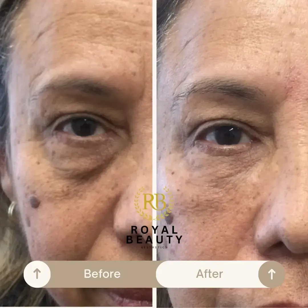 Royal Beauty Aesthetics undereye filler result — Draper, UT