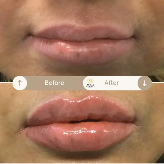 Lip Filler result at Royal Beauty Aesthetics in Draper, UT