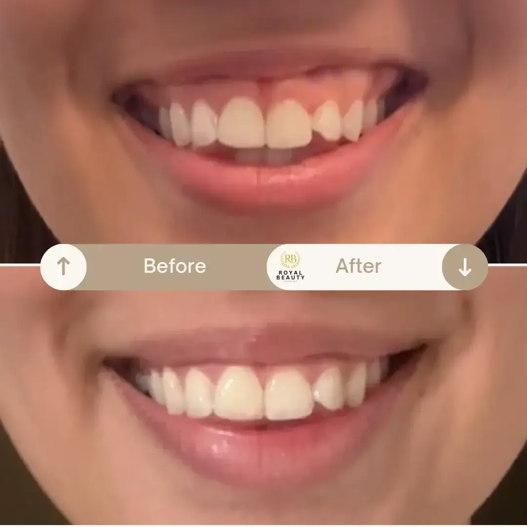 Royal Beauty Aesthetics botox result — Draper, UT
