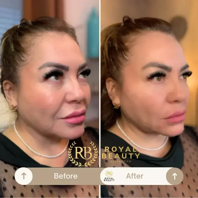 Jawline Filler result at Royal Beauty Aesthetics in Draper, UT