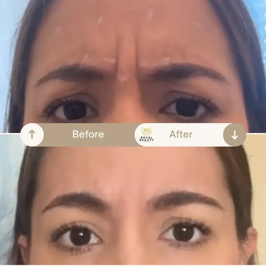 Royal Beauty Aesthetics botox result — Draper, UT