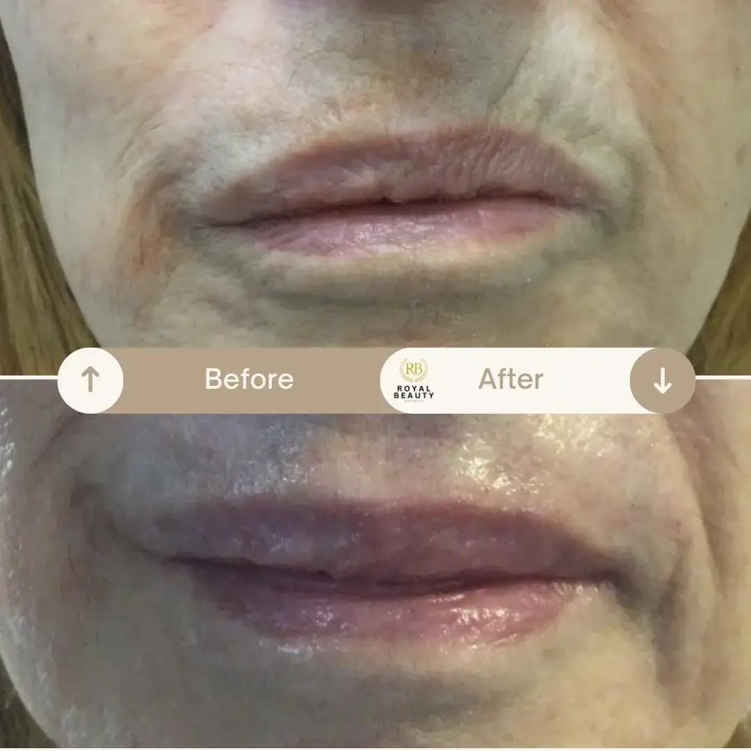 Royal Beauty Aesthetics lip filler result — Draper, UT