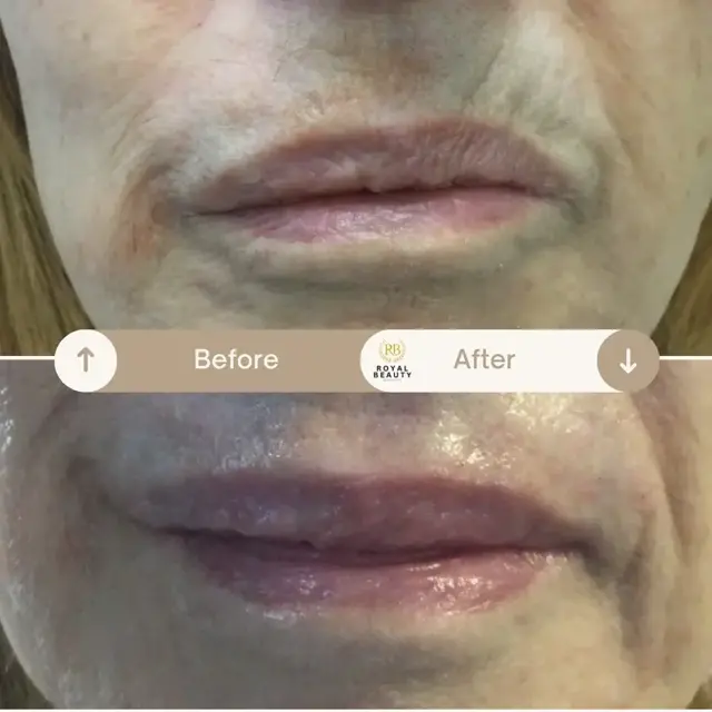 Lip Filler result at Royal Beauty Aesthetics in Draper, UT