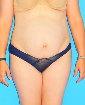 Mini Tummy Tuck before at Plastic Surgeon Baltimore, MD: Dr. Alyson Wells in Cockeysville, MD