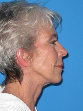 Facelift after at Plastic Surgeon Baltimore, MD: Dr. Alyson Wells in Cockeysville, MD
