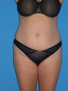 Mini Tummy Tuck before at Plastic Surgeon Baltimore, MD: Dr. Alyson Wells in Cockeysville, MD