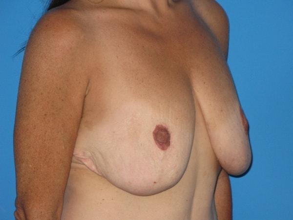Breast Lift before at Plastic Surgeon Baltimore, MD: Dr. Alyson Wells in Cockeysville, MD