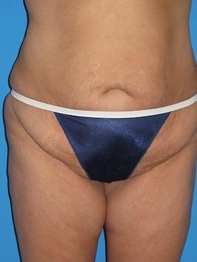 Mini Tummy Tuck before at Plastic Surgeon Baltimore, MD: Dr. Alyson Wells in Cockeysville, MD
