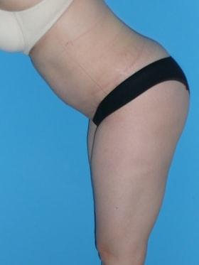 Mini Tummy Tuck after at Plastic Surgeon Baltimore, MD: Dr. Alyson Wells in Cockeysville, MD