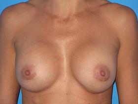 Fat Transfer Breast Augmentation after at Plastic Surgeon Baltimore, MD: Dr. Alyson Wells in Cockeysville, MD