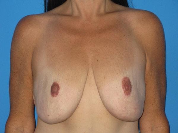 Breast Lift before at Plastic Surgeon Baltimore, MD: Dr. Alyson Wells in Cockeysville, MD