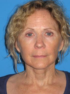 Plastic Surgeon Baltimore, MD: Dr. Alyson Wells after — Cockeysville, MD