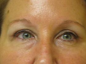 Blepharoplasty after at Plastic Surgeon Baltimore, MD: Dr. Alyson Wells in Cockeysville, MD