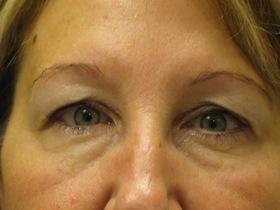 Blepharoplasty before at Plastic Surgeon Baltimore, MD: Dr. Alyson Wells in Cockeysville, MD