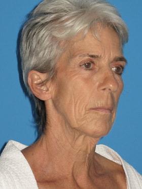 Facelift before at Plastic Surgeon Baltimore, MD: Dr. Alyson Wells in Cockeysville, MD