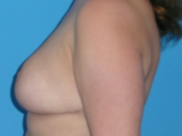 Plastic Surgeon Baltimore, MD: Dr. Alyson Wells breast reduction after — Cockeysville, MD