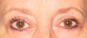 Blepharoplasty after at Plastic Surgeon Baltimore, MD: Dr. Alyson Wells in Cockeysville, MD