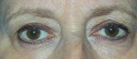 Blepharoplasty before at Plastic Surgeon Baltimore, MD: Dr. Alyson Wells in Cockeysville, MD