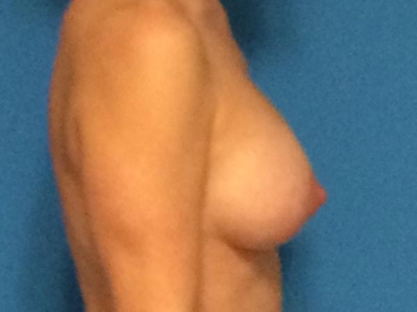 Breast Lift after at Plastic Surgeon Baltimore, MD: Dr. Alyson Wells in Cockeysville, MD