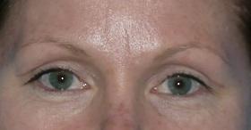 Blepharoplasty after at Plastic Surgeon Baltimore, MD: Dr. Alyson Wells in Cockeysville, MD