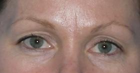 Blepharoplasty before at Plastic Surgeon Baltimore, MD: Dr. Alyson Wells in Cockeysville, MD