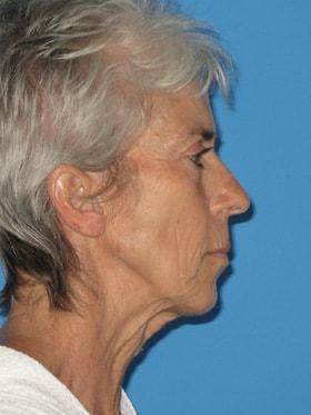 Facelift before at Plastic Surgeon Baltimore, MD: Dr. Alyson Wells in Cockeysville, MD