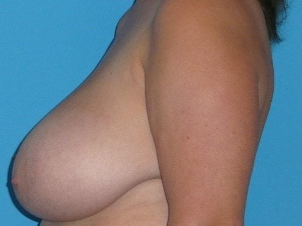 Breast Reduction before at Plastic Surgeon Baltimore, MD: Dr. Alyson Wells in Cockeysville, MD