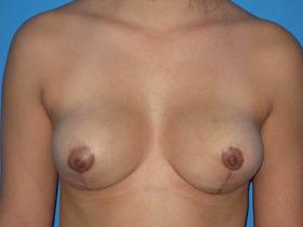 Breast Reduction after at Plastic Surgeon Baltimore, MD: Dr. Alyson Wells in Cockeysville, MD