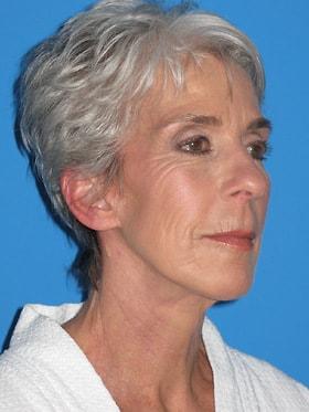 Facelift after at Plastic Surgeon Baltimore, MD: Dr. Alyson Wells in Cockeysville, MD